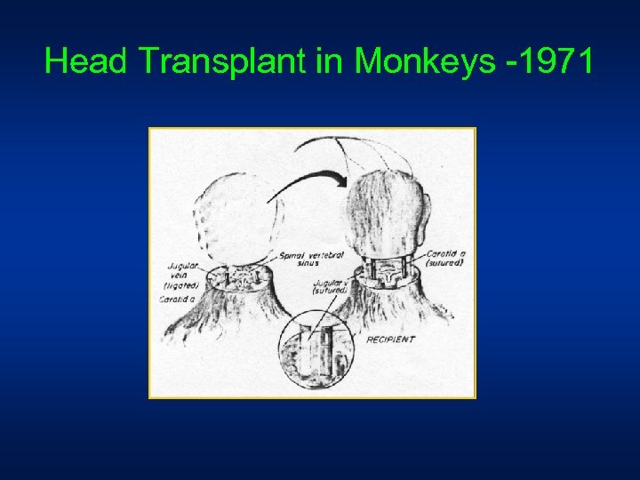 Head Transplant in Monkeys -1971 