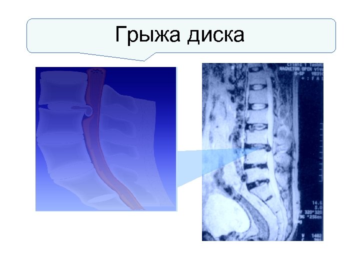 Грыжа диска 