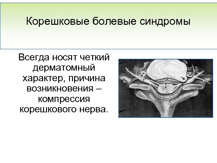 Корешковые болевые синдромы Всегда носят четкий дерматомный характер, причина возникновения – компрессия корешкового нерва.