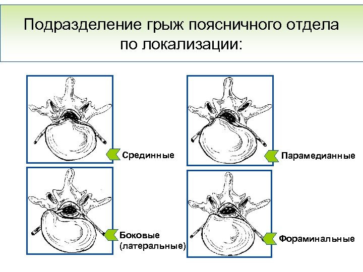 Подразделение грыж поясничного отдела по локализации: Срединные Боковые (латеральные) Парамедианные Фораминальные 