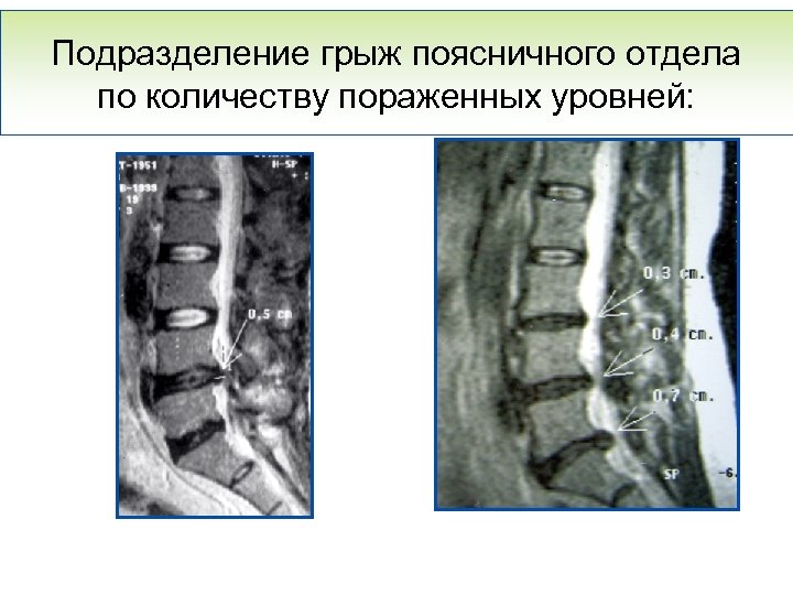 Подразделение грыж поясничного отдела по количеству пораженных уровней: 