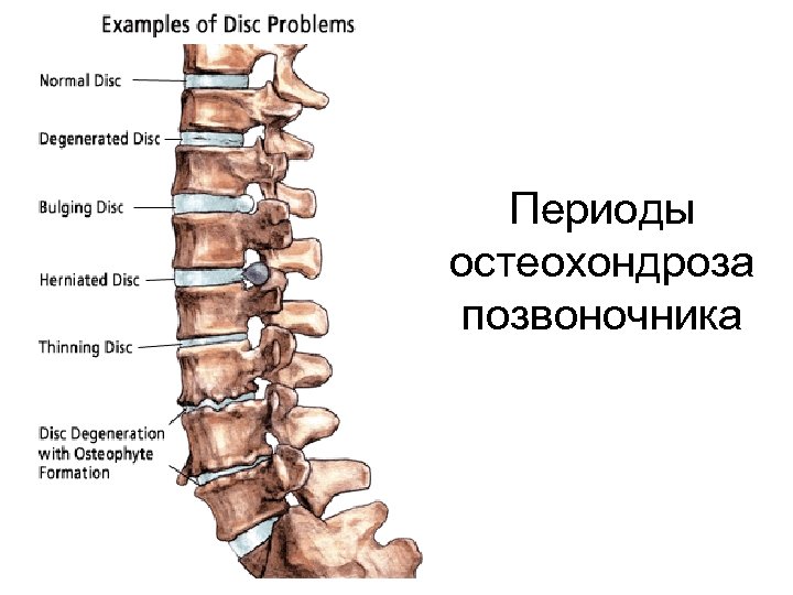 Периоды остеохондроза позвоночника 