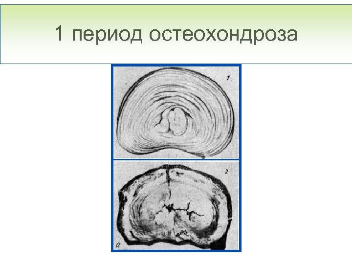 1 период остеохондроза 