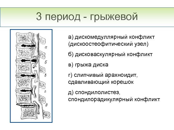 3 период - грыжевой а) дискомедуллярный конфликт (дискоостеофитический узел) б) дисковаскулярный конфликт в) грыжа