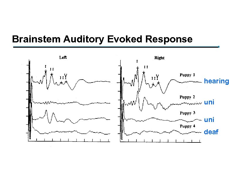 Brainstem Auditory Evoked Response hearing uni deaf 