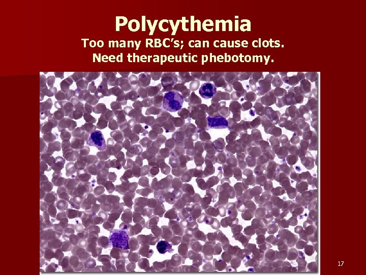Polycythemia Too many RBC’s; can cause clots. Need therapeutic phebotomy. 17 