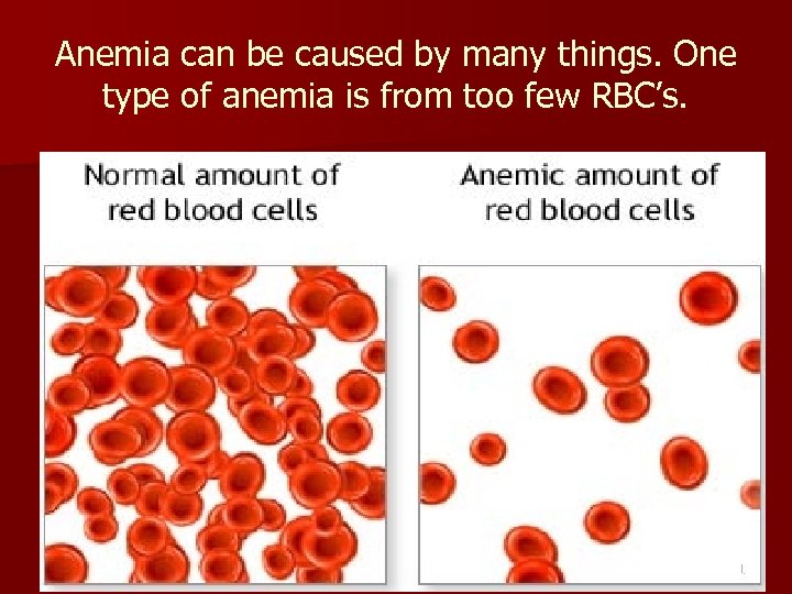 Anemia can be caused by many things. One type of anemia is from too