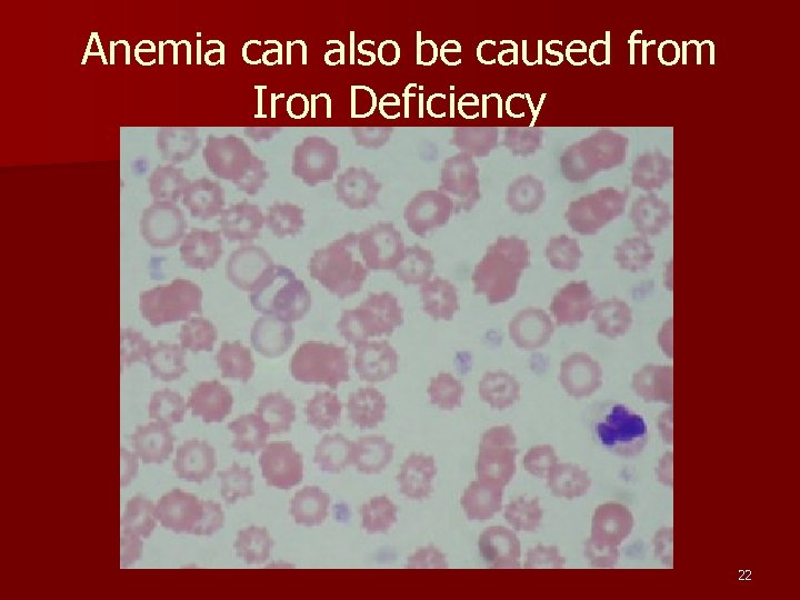 Anemia can also be caused from Iron Deficiency 22 