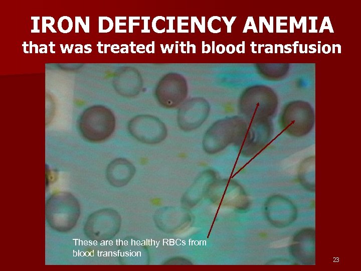 IRON DEFICIENCY ANEMIA that was treated with blood transfusion These are the healthy RBCs