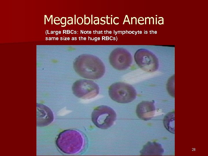 Megaloblastic Anemia (Large RBCs: Note that the lymphocyte is the same size as the