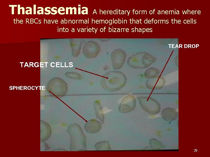 Thalassemia A hereditary form of anemia where the RBCs have abnormal hemoglobin that deforms