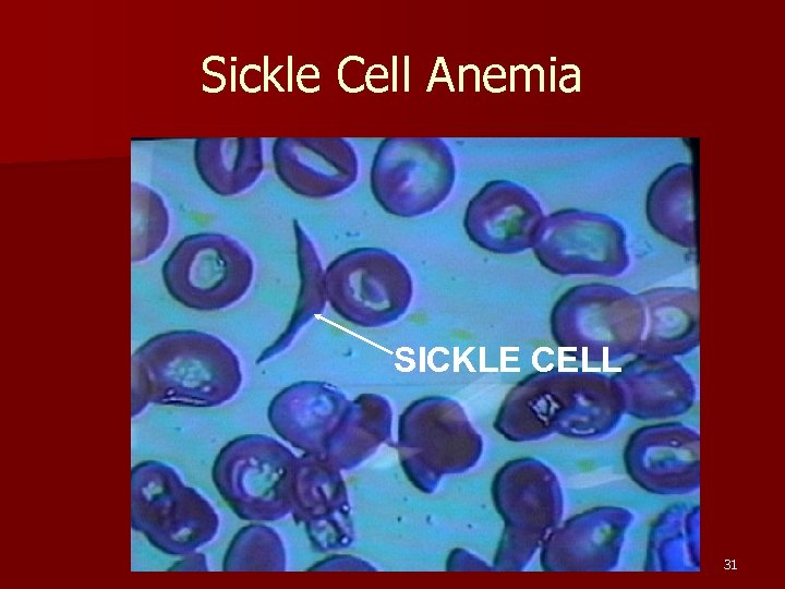 Sickle Cell Anemia SICKLE CELL 31 