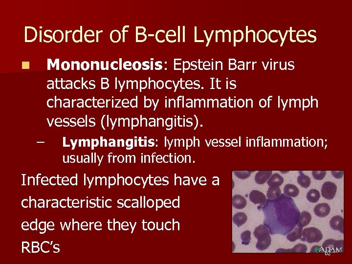 Disorder of B-cell Lymphocytes Mononucleosis: Epstein Barr virus attacks B lymphocytes. It is characterized