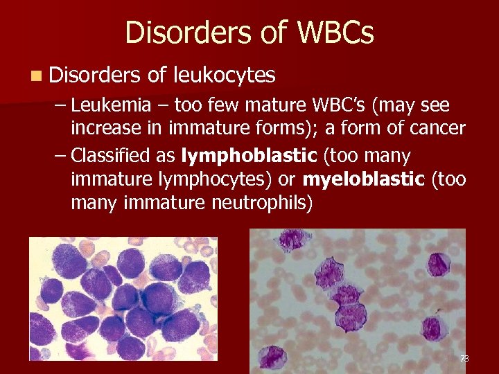 Disorders of WBCs n Disorders of leukocytes – Leukemia – too few mature WBC’s