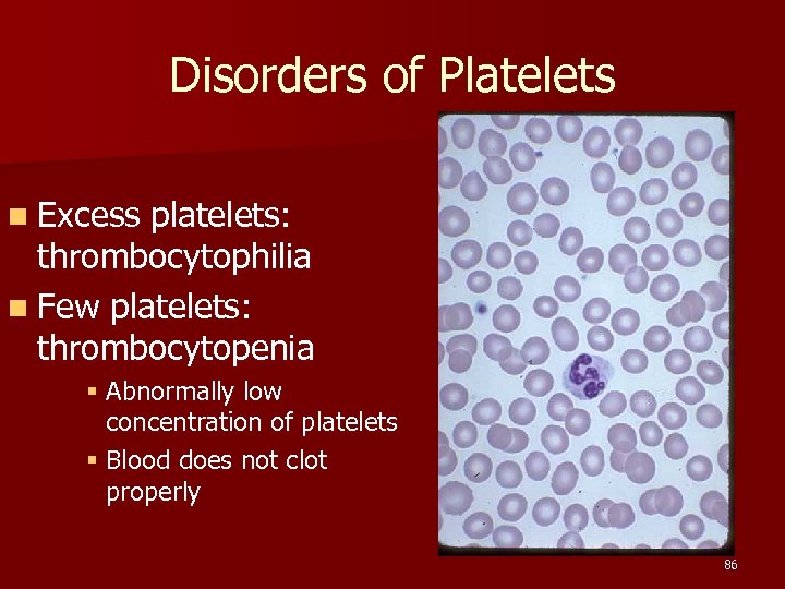 Disorders of Platelets n Excess platelets: thrombocytophilia n Few platelets: thrombocytopenia § Abnormally low
