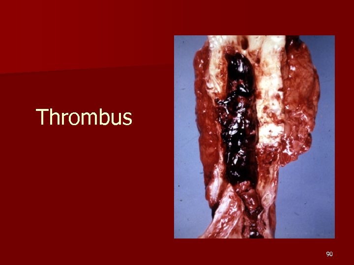 Thrombus 90 