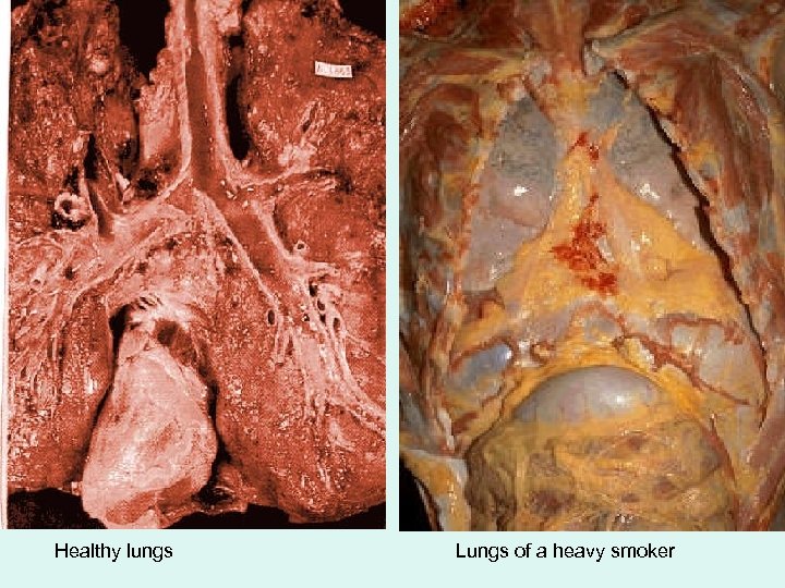 Healthy lungs Lungs of a heavy smoker 