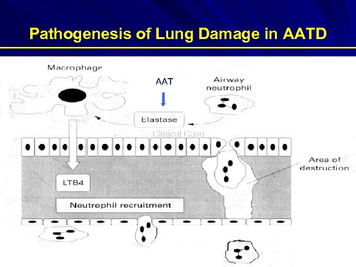 Pathogenesis of Lung Damage in AATD AAT Clinical Case 