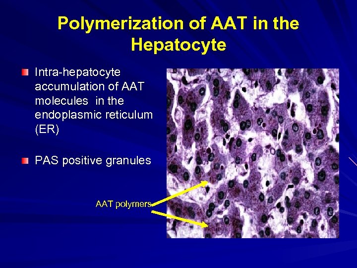 Polymerization of AAT in the Hepatocyte Intra-hepatocyte accumulation of AAT molecules in the endoplasmic