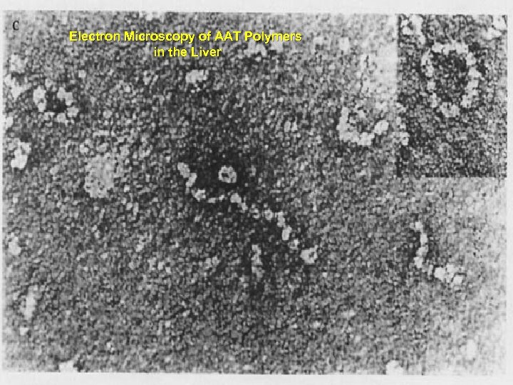 Electron Microscopy of AAT Polymers in the Liver 