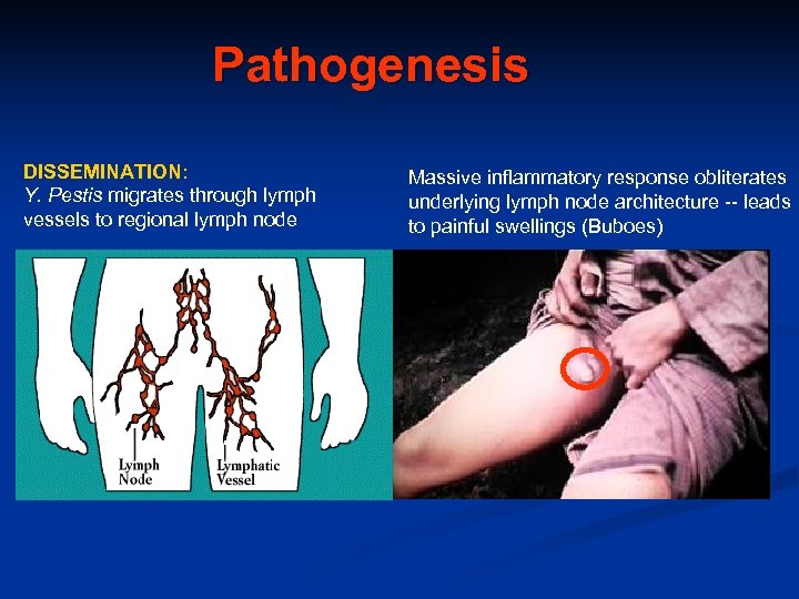 Pathogenesis DISSEMINATION: Y. Pestis migrates through lymph vessels to regional lymph node Massive inflammatory