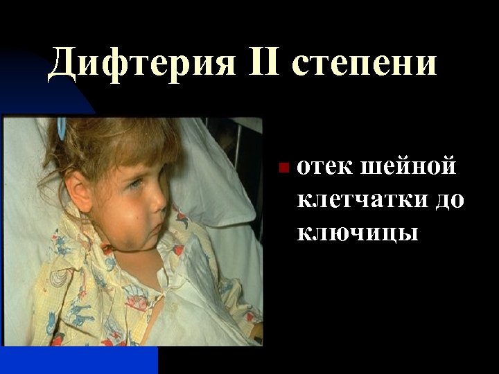 Дифтерия II степени n отек шейной клетчатки до ключицы 