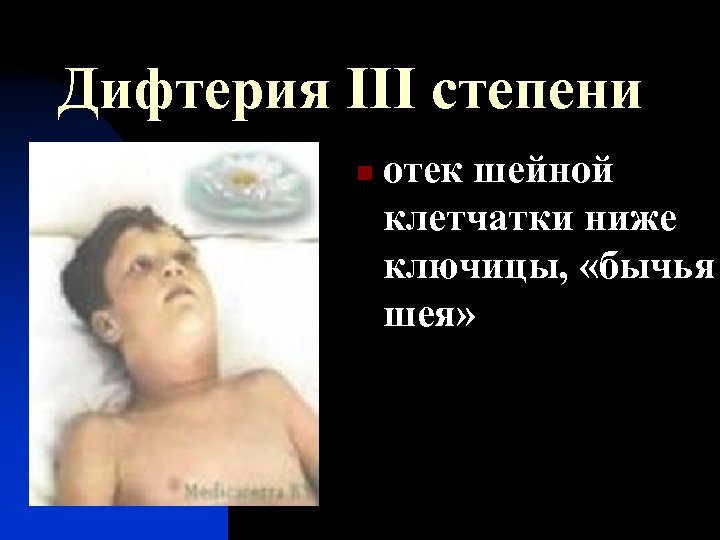 Дифтерия III степени n отек шейной клетчатки ниже ключицы, «бычья шея» 