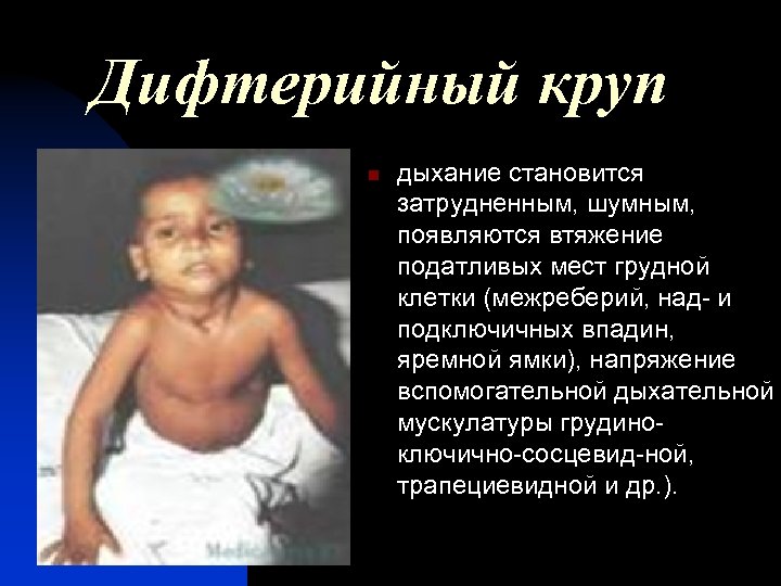Дифтерийный круп n дыхание становится затрудненным, шумным, появляются втяжение податливых мест грудной клетки (межреберий,