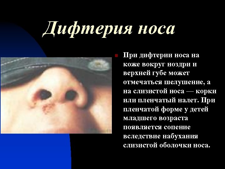 Дифтерия носа n При дифтерии носа на коже вокруг ноздри и верхней губе может