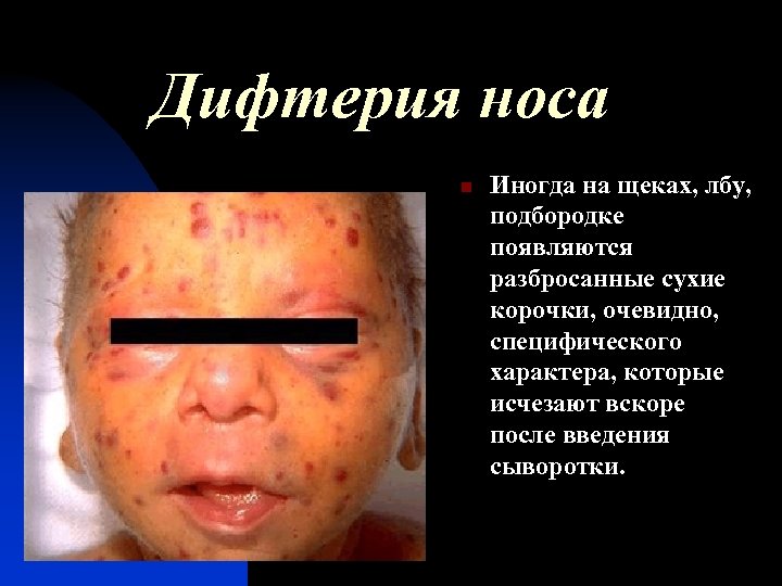 Дифтерия носа n Иногда на щеках, лбу, подбородке появляются разбросанные сухие корочки, очевидно, специфического