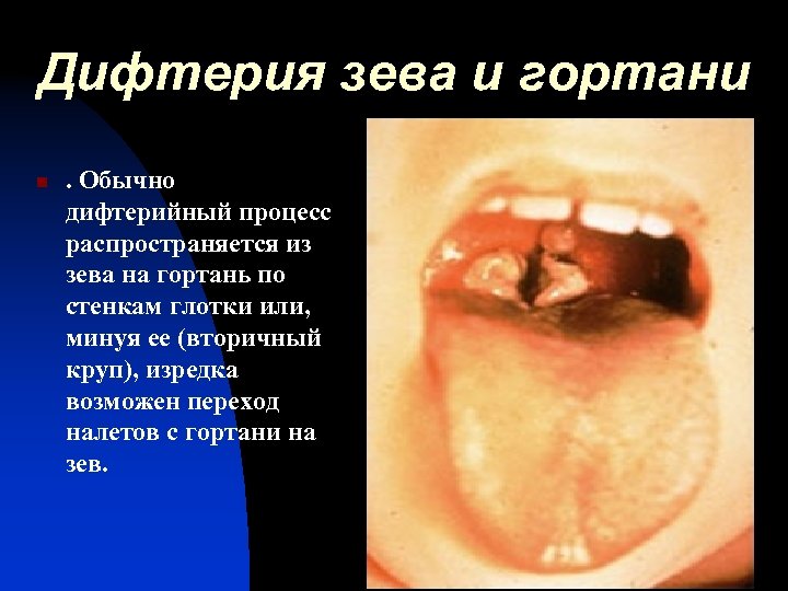 Дифтерия зева и гортани n . Обычно дифтерийный процесс распространяется из зева на гортань