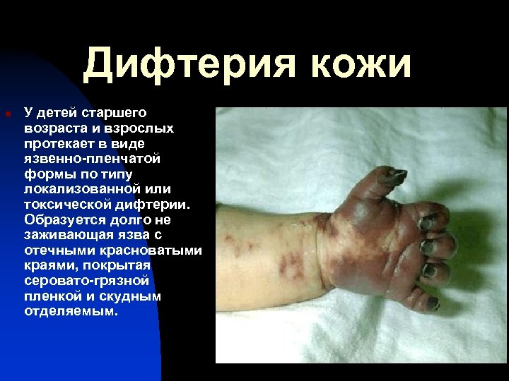 Дифтерия кожи n У детей старшего возраста и взрослых протекает в виде язвенно-пленчатой формы