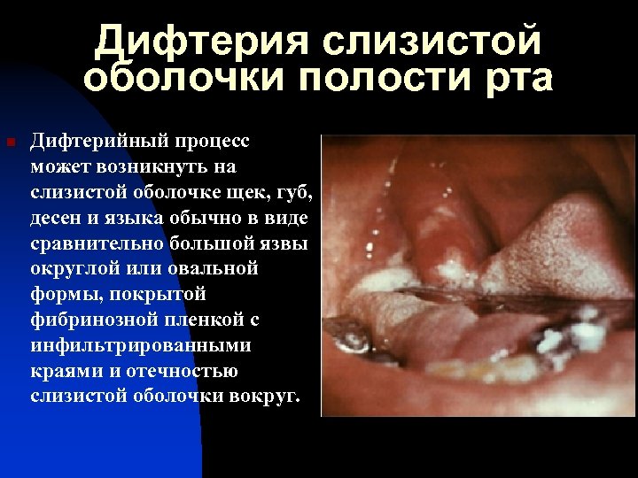 Дифтерия слизистой оболочки полости рта n Дифтерийный процесс может возникнуть на слизистой оболочке щек,