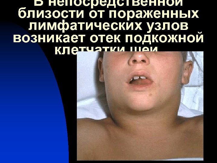 В непосредственной близости от пораженных лимфатических узлов возникает отек подкожной клетчатки шеи. 