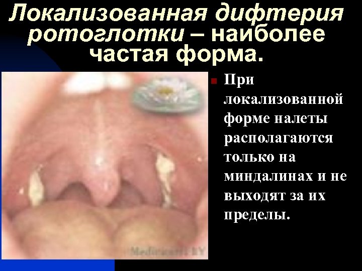 Локализованная дифтерия ротоглотки – наиболее частая форма. n При локализованной форме налеты располагаются только
