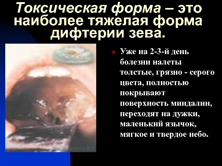 Токсическая форма – это наиболее тяжелая форма дифтерии зева. n Уже на 2 -3