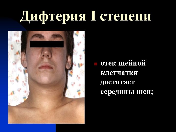 Дифтерия I степени n отек шейной клетчатки достигает середины шеи; 