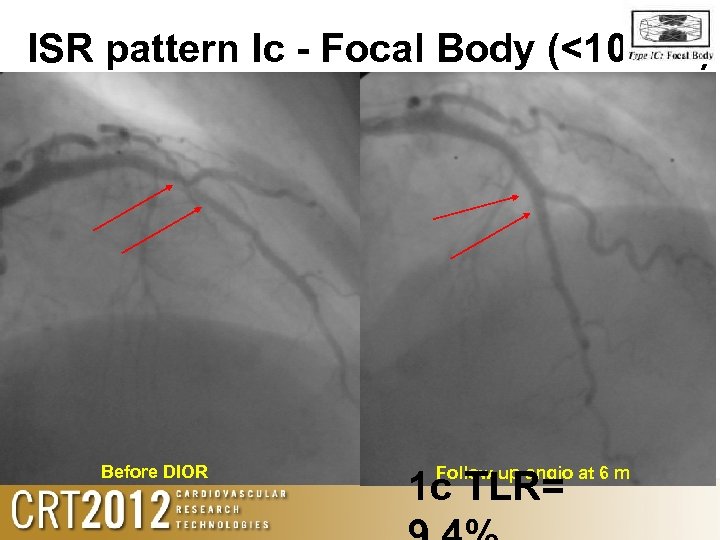 ISR pattern Ic - Focal Body (<10 mm). Before DIOR Follow up angio at
