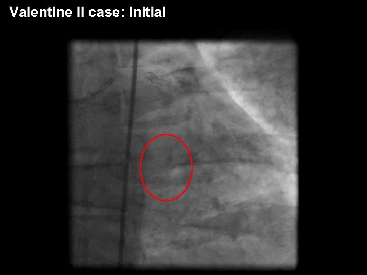 Valentine II case: Initial 
