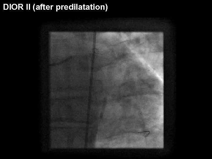 DIOR II (after predilatation) 