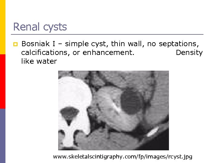 Renal cysts p Bosniak I – simple cyst, thin wall, no septations, calcifications, or