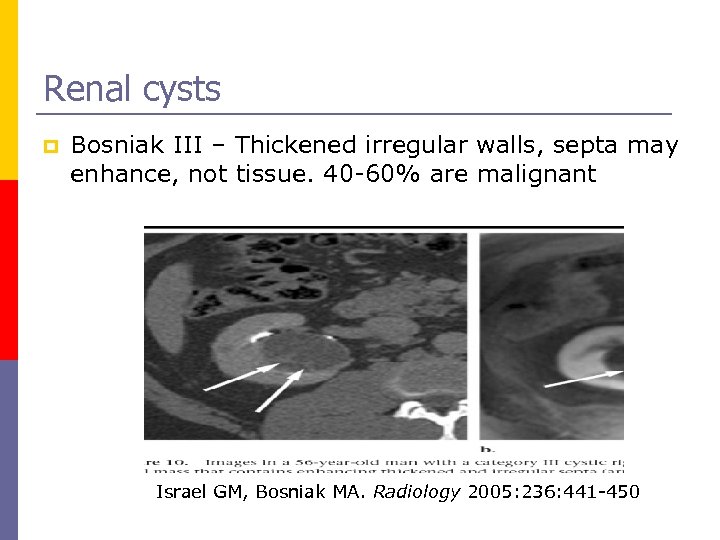 Renal cysts p Bosniak III – Thickened irregular walls, septa may enhance, not tissue.