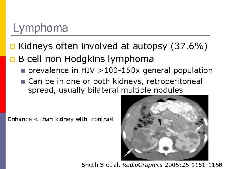 Lymphoma Kidneys often involved at autopsy (37. 6%) p B cell non Hodgkins lymphoma