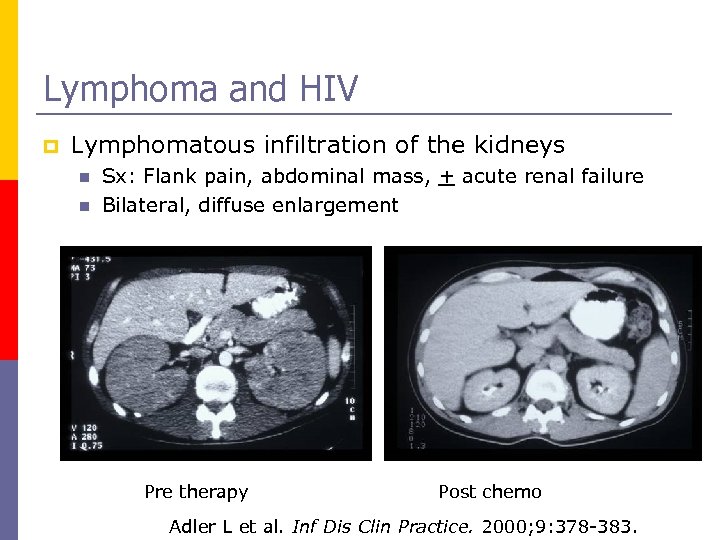 Lymphoma and HIV p Lymphomatous infiltration of the kidneys n n Sx: Flank pain,