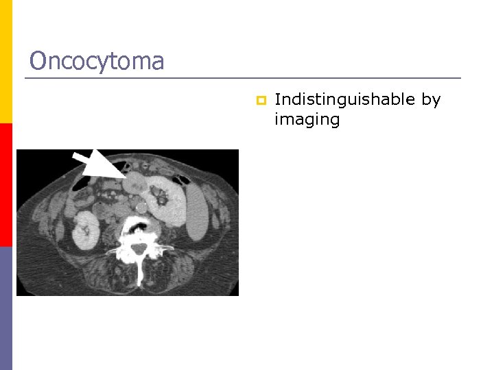 Oncocytoma p Indistinguishable by imaging 