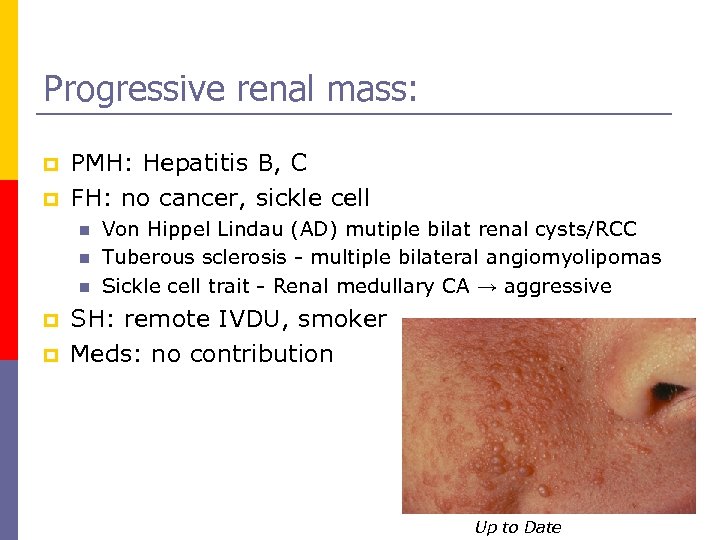 Progressive renal mass: p p PMH: Hepatitis B, C FH: no cancer, sickle cell