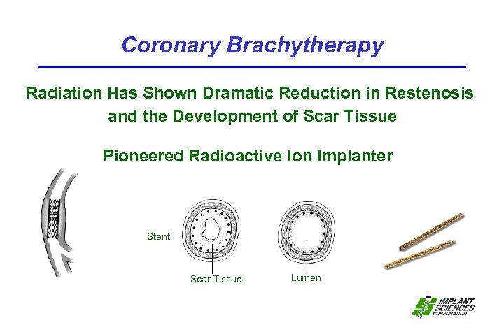 Coronary Brachytherapy Radiation Has Shown Dramatic Reduction in Restenosis and the Development of Scar