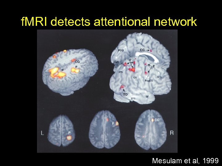 f. MRI detects attentional network Mesulam et al, 1999 