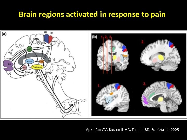 Brain regions activated in response to pain Apkarian AV, Bushnell MC, Treede RD, Zubieta