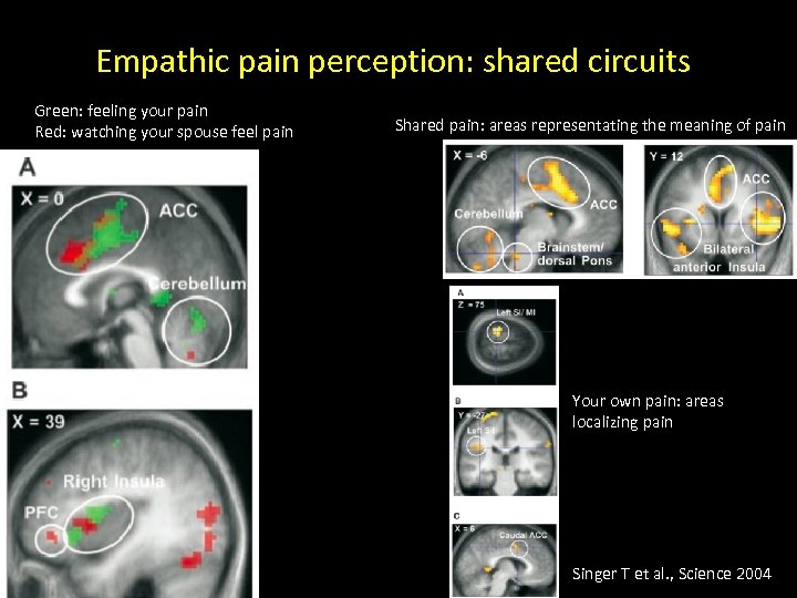 Empathic pain perception: shared circuits Green: feeling your pain Red: watching your spouse feel